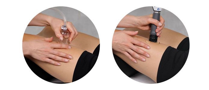 shockwave-Patellar-tendinitis