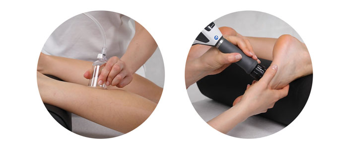 shockwave-Plantar-fasciitis