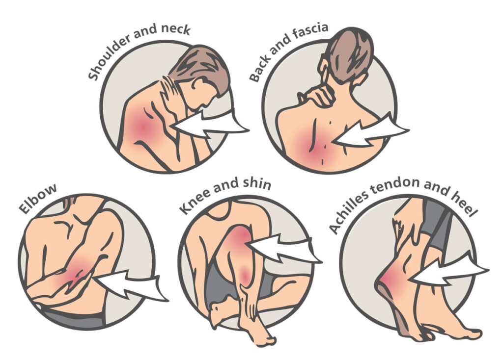 shockwave-therapy-treatment-areas
