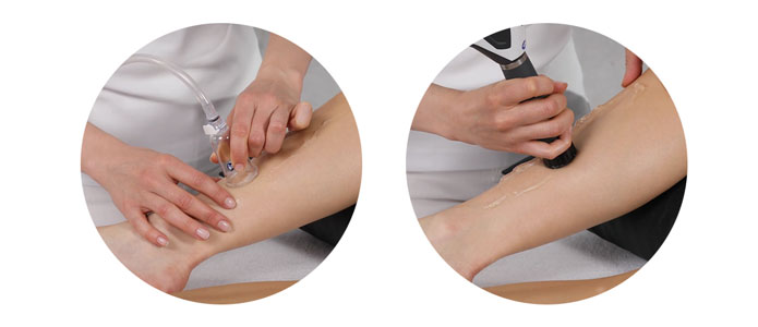 shokwave-Tibial-stress-syndrome